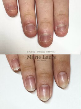 マリーロール 梅田店(Marie Laure)/自爪育成/深爪矯正/ネイルケア