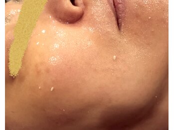 フワリ(Fuwari)/角栓がポロポロにょきにょき