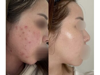 ミミルーチェ(mimiluce)/リアボーテ×若よもぎ蒸し