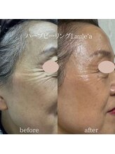 ラウレア/ハーブピーリング×小顔