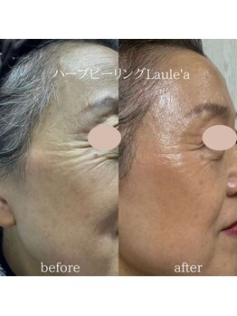 ラウレア/ハーブピーリング×小顔