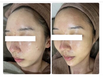 ホワイトアクア 北千住店(WHITE AQUA)/ハーブピーリング/肌質改善/毛穴