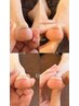 【その日に痛みを軽減】巻き爪矯正◆1趾につき