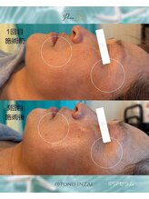 ポノ(Pono)/三回施術のお客様☆