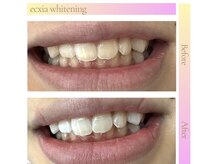 エクシア ホワイトニング 伊勢崎店/