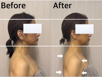 ベール(BEHL)/コルギのBefore After