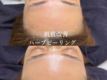 ラティエ(Latier)/おでこつや爆誕