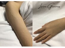 ラリマ グラマラス(Larima Glamorous)/キッズ脱毛（男子・女子）