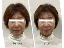 スリー治療院 伏見桃山(THREE治療院)/【マリオネット改善】小顔矯正