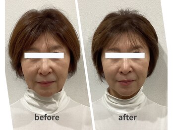 スリー治療院 伏見桃山(THREE治療院)/【マリオネット改善】小顔矯正