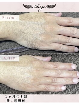 アンジェ(Ange)/手の甲脱毛 before/after