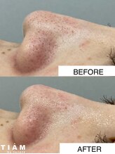 ティアム バイ テトテ 神戸三宮(TIAM by tetote)/ハイドロフェイシャル 