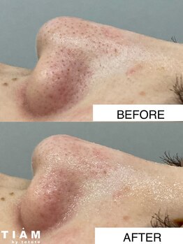 ティアム バイ テトテ 神戸三宮(TIAM by tetote)/ハイドロフェイシャル