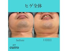 アクト クロ(ACT curro)/【ヒゲ全体】脱毛施術例