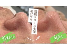 ルー(Lu)/【大人気】毛穴洗浄