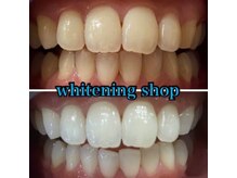 ホワイトニングショップ 本八幡店/Before&After美白ホワイトニング