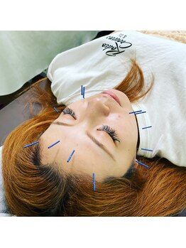 ヒューマン鍼灸接骨院/少ない本数で効果◎の美容鍼♪