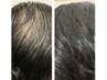【うす毛】ダーマ鍼+ヒト幹細胞で未来の髪のために今からできる事