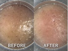 ドアディ(Doordie)/韓流毛穴洗浄スキンサクション