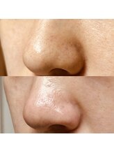 ラウレア/ハーブピーリング×毛穴洗浄