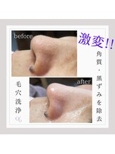 ウィズティ 沖縄市店(with.T)/毛穴洗浄コース