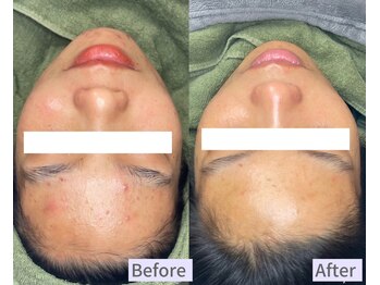 ちらちゅら/クリスティーナ【施術3回】経過