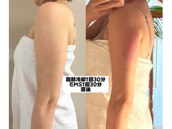 スリム(SLIM by lily of the valley)/腕の冷却直後！