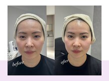 スキンラボ ドットシキブ 厚木海老名店(skinlabo .sikibu)/ビフォーアフター