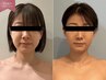 【3回集中】脂肪燃焼剤5ml導入☆切らない小顔形成でフェイスラインすっきり