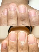 マリーロール 梅田店(Marie Laure)/自爪育成/深爪矯正/ネイルケア