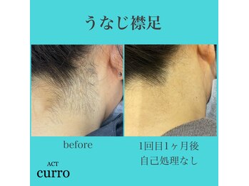 アクト クロ(ACT curro)/【うなじ襟足】脱毛施術例