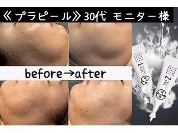 サロンスペース/水光肌【プラピール】モニター様