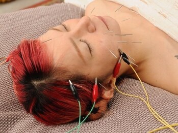 トナリ鍼灸院の写真/憧れの小顔を手に入れたい方にオススメ！＜小顔特化＞美容鍼＋カッサ＋小顔コルギ　80分　¥7,000