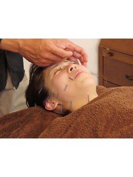 鍼灸施術を受けたい