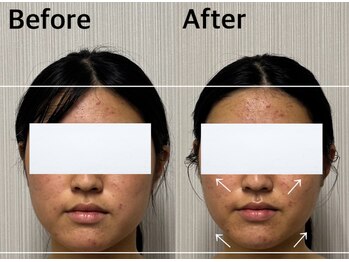 ベール(BEHL)/コルギのBefore After