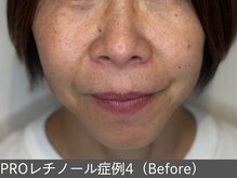 オアシスラグーン(OASIS LAGOON)/レチノール（症例4 before）