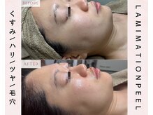 ルリエベル(Relier Belle)/ラミネーションピール1回