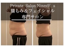 ナインズ(Nines 9'S)/施術例