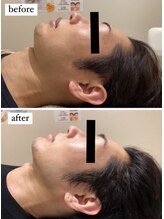 エイシスグロウ(asis glow.)/効果写真