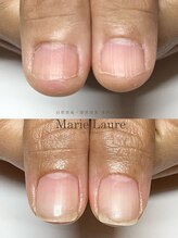 マリーロール 梅田店(Marie Laure)/自爪育成/深爪矯正/ネイルケア