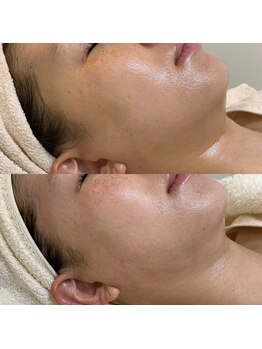 ブリス(Bliss)/リアボーテハーブトリートメント