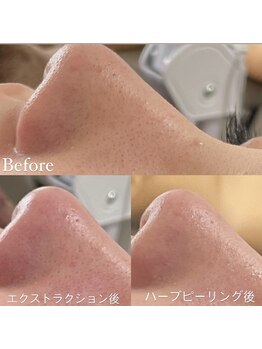 エマ(emma)/二つのメニュー同時施術が可能に