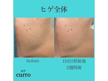 アクト クロ(ACT curro)/【ヒゲ全体】脱毛施術例