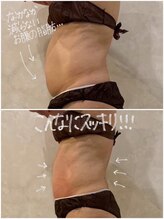 OBS新潟整骨院/脂肪冷却ダイエット