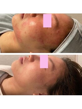 サロン ラズリ 久留米店(SALON Lazuli)/【イオン導入】赤ら顔