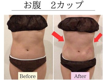リボーン(REBORN)/お腹 2カップ