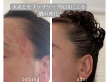 ヨサパーク エミリア(YOSA PARK Emiria)/水素浴とセリッサソープ使用