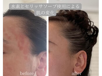 ヨサパーク エミリア(YOSA PARK Emiria)/水素浴とセリッサソープ使用