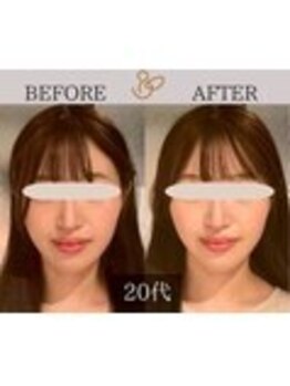 チョコバリ 錦糸町店(chocobari)/小顔×リフトアップ(美容鍼)20代