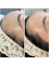 ザ ビードットデザイン(The b. design)/顔脱毛